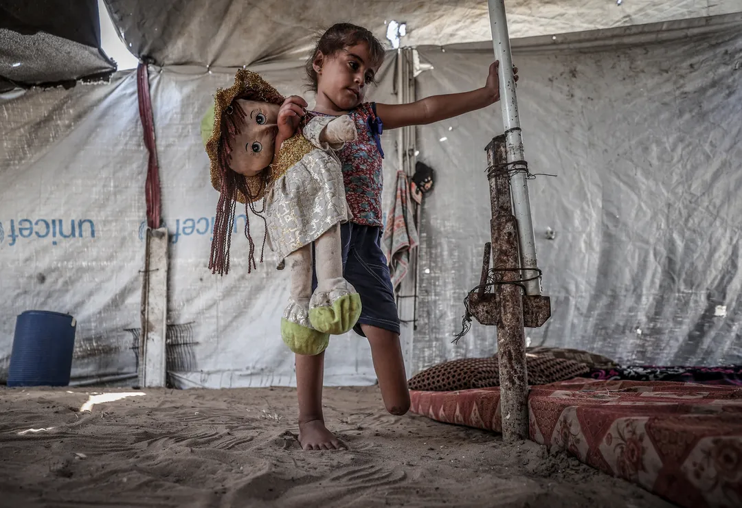 4-year-old Gazan girl dreams of walking, playing again after amputation