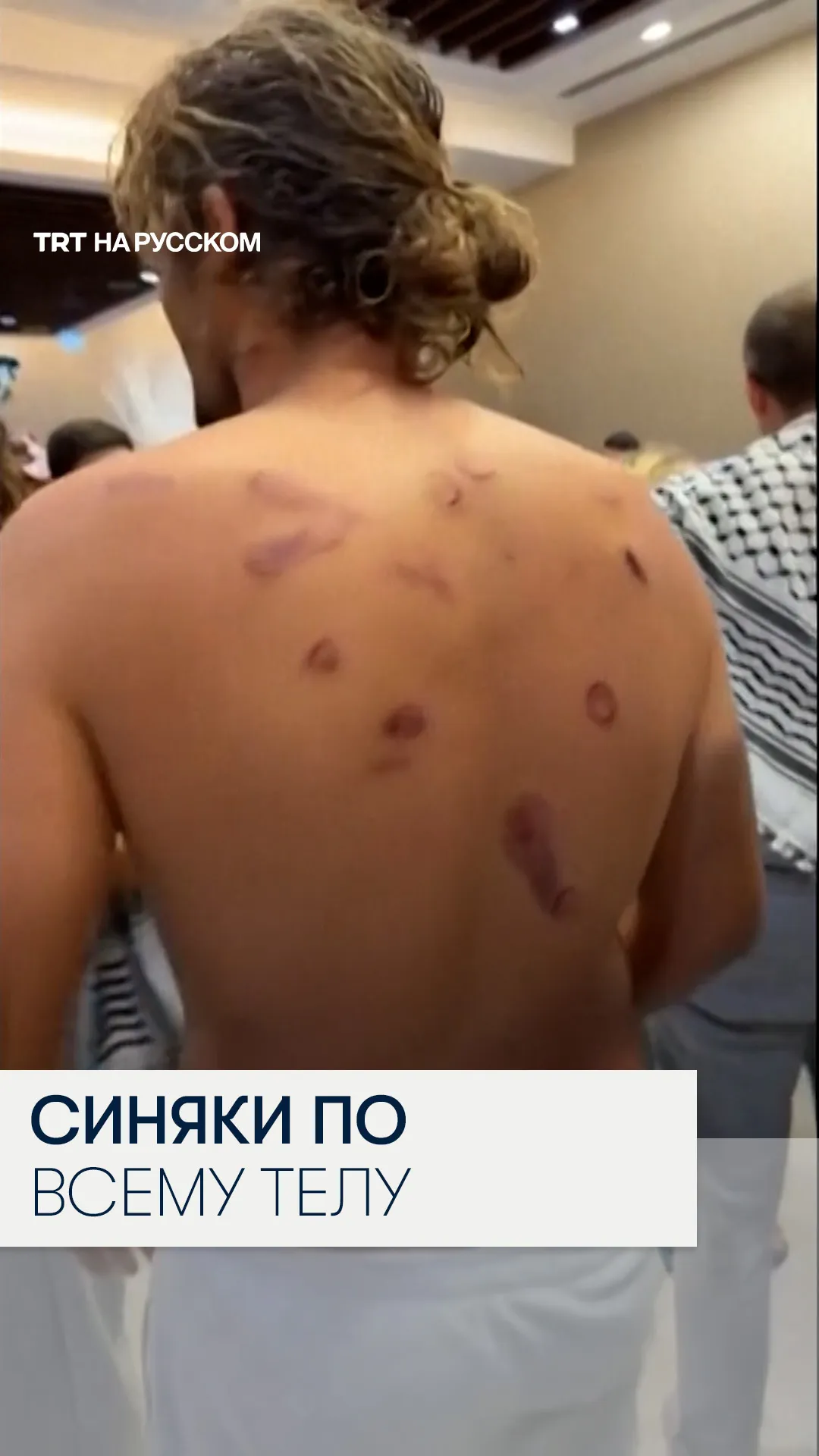 Активист флотилии «Сумуд» показал синяки после задержания израильскими военными