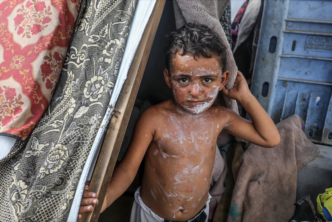 اقوام متحدہ: غزہ کے بچوں میں تیزی سے خسرہ پھیل رہا ہے
