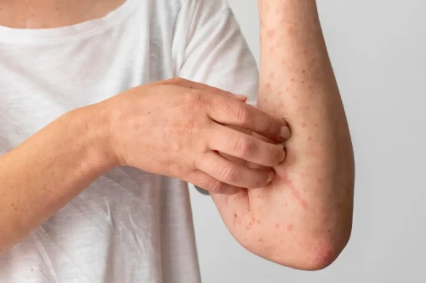 Schurftepidemie blijft hardnekkig in Nederland: Voorlichting en nieuwe app moeten tij keren