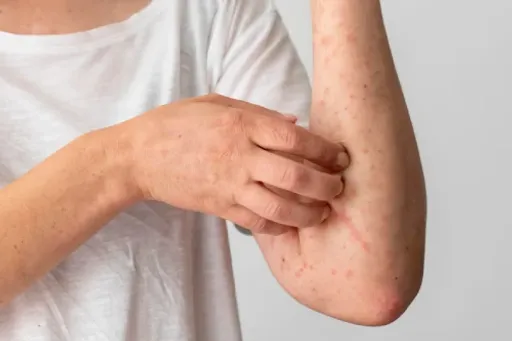 Schurftepidemie blijft hardnekkig in Nederland: Voorlichting en nieuwe app moeten tij keren
