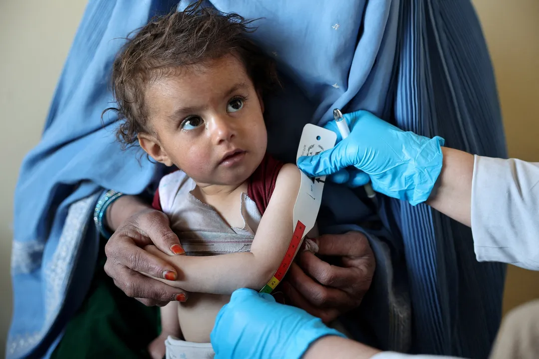UNICEF: Egy millió gyermek halhat meg Afganisztánban a súlyos akut alultápláltság miatt