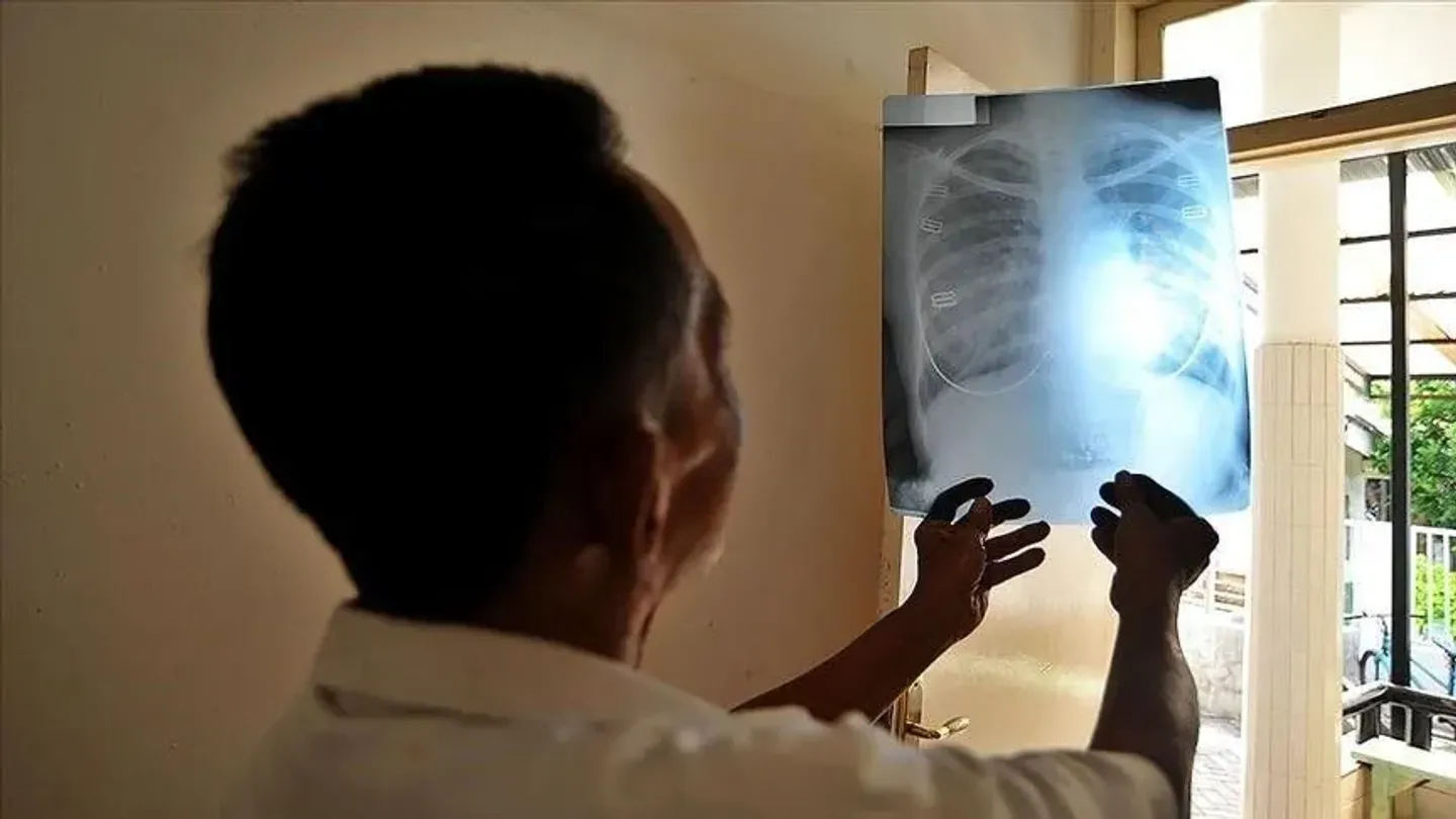 Nigeria's Plateau State records 11,000 tuberculosis cases in 2026