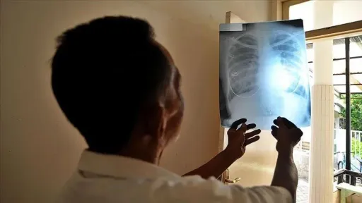 Nigeria's Plateau State records 11,000 tuberculosis cases in 2026